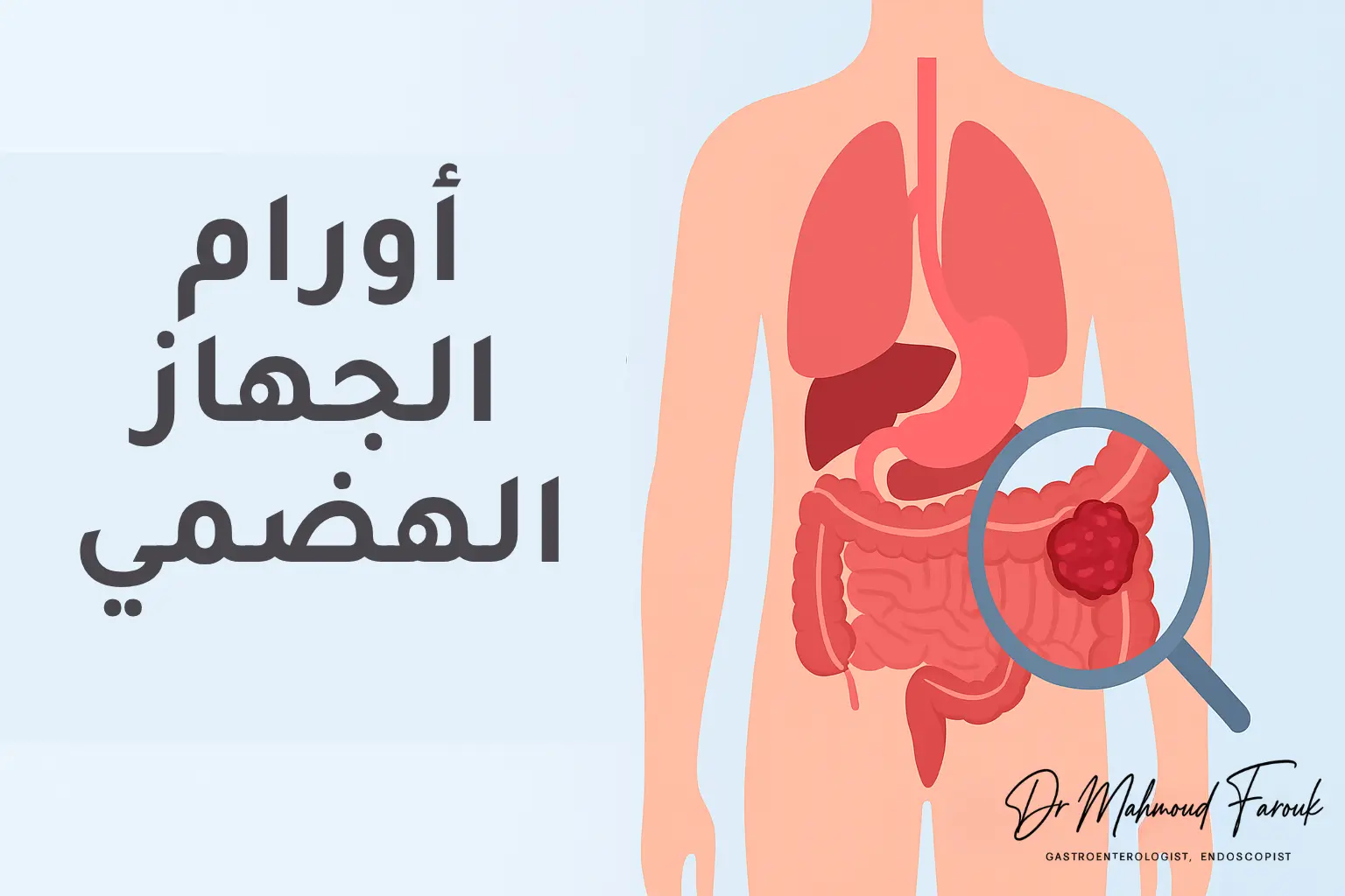 أورام الجهاز الهضمي