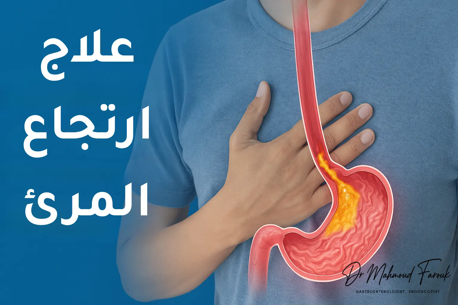 علاج ارتجاع المريء