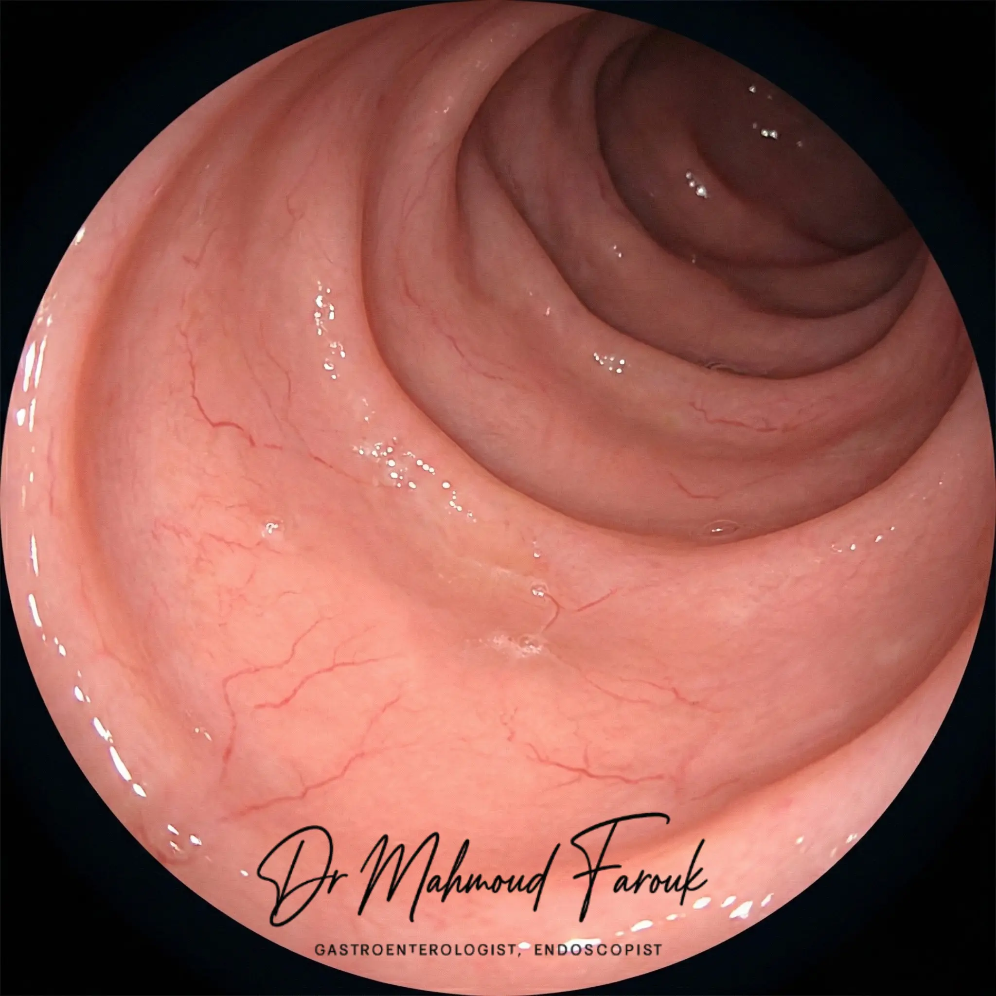 صورة منظار حقيقية لمعدة طبيعية سليمة تظهر البطانة الوردية الناعمة والأوعية الدموية الدقيقة بدون أي التهاب أو احمرار