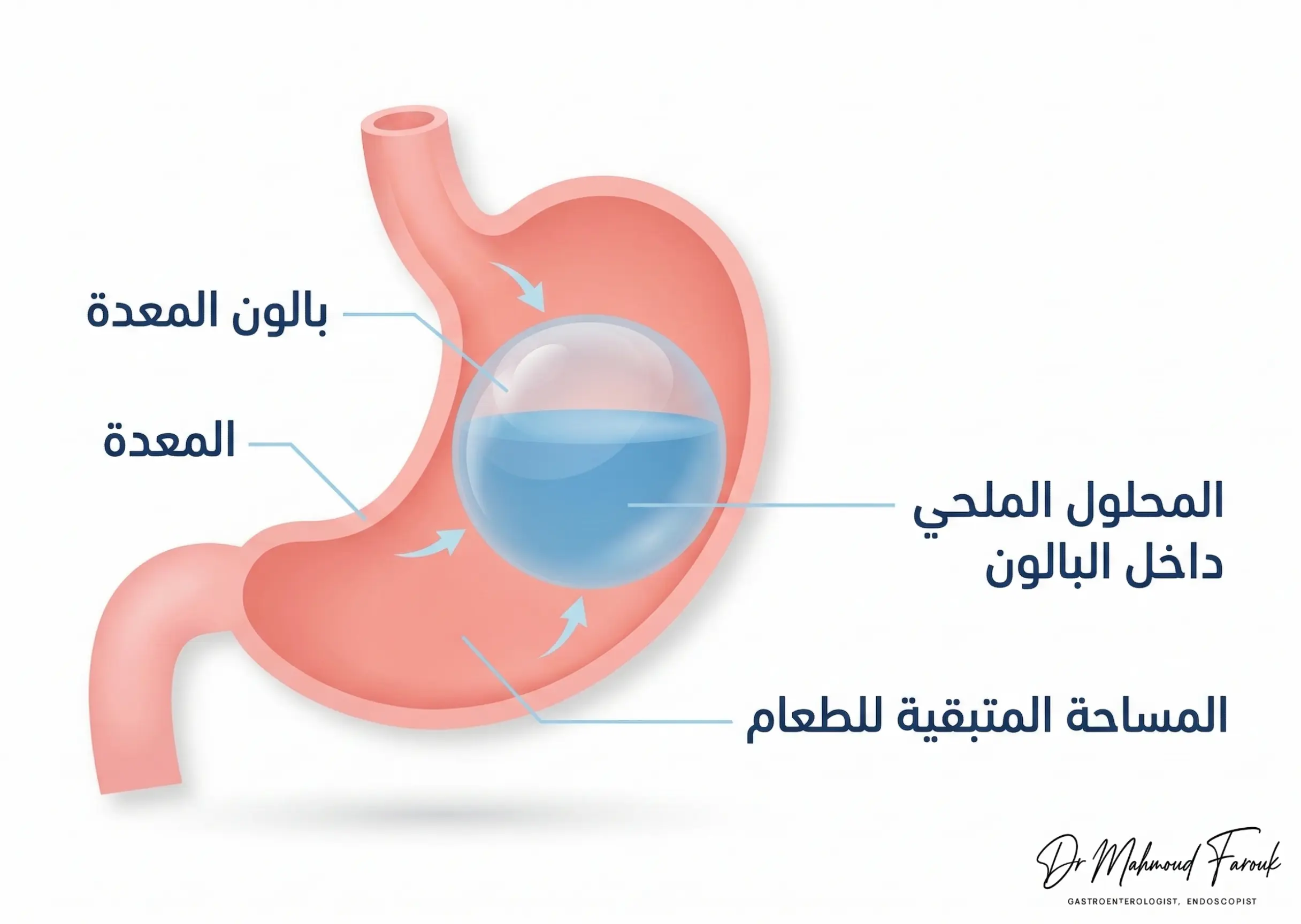  شكل بالون المعدة