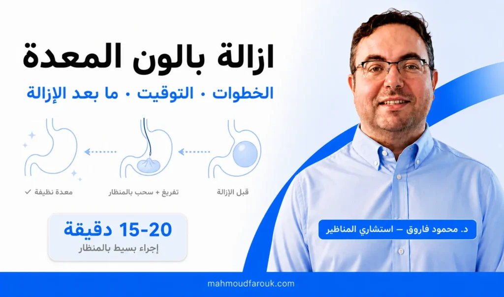 ازالة بالون المعدة