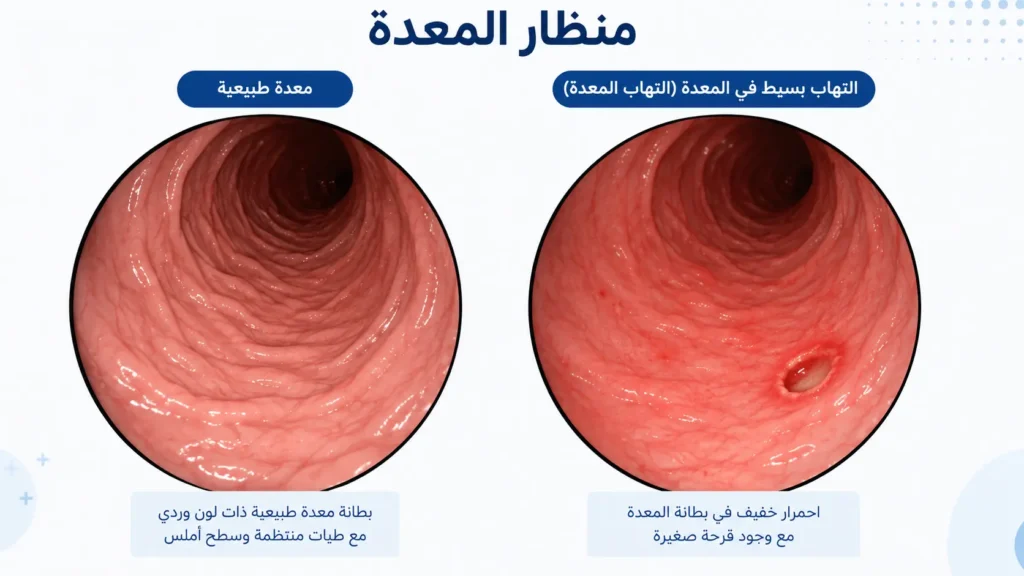 شكل بطانة المعدة في المنظار معدة سليمة وردية مقابل معدة ملتهبة