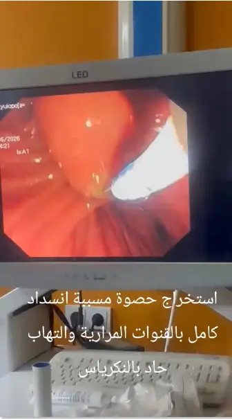 تسليك القناة المرارية بالمنظار وإزالة حصوة - د. محمود فاروق