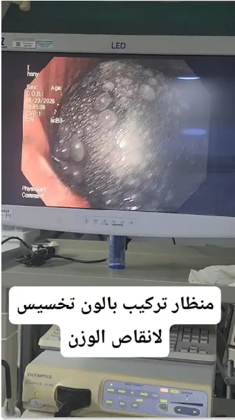 تركيب بالون المعدة بالمنظار - د. محمود فاروق