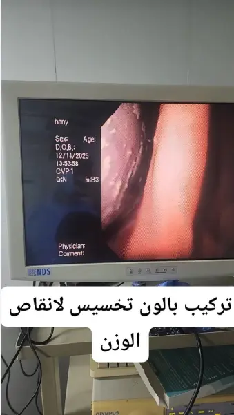 تركيب بالون المعدة بالمنظار للتخسيس - د. محمود فاروق