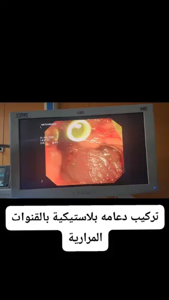 تركيب دعامة القناة المرارية بالمنظار - د. محمود فاروق