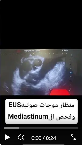 منظار EUS لفحص المنصف والعقد الليمفاوية - د. محمود فاروق
