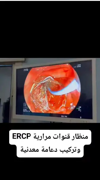 تركيب دعامة معدنية في القناة المرارية بالمنظار - د. محمود فاروق