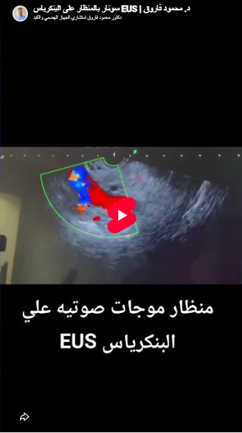 منظار EUS على البنكرياس لاستبعاد كتلة في الرأس - د. محمود فاروق